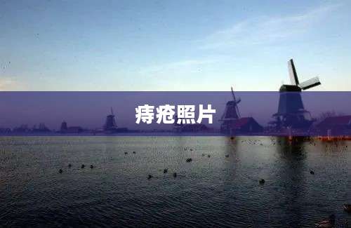 痔疮照片